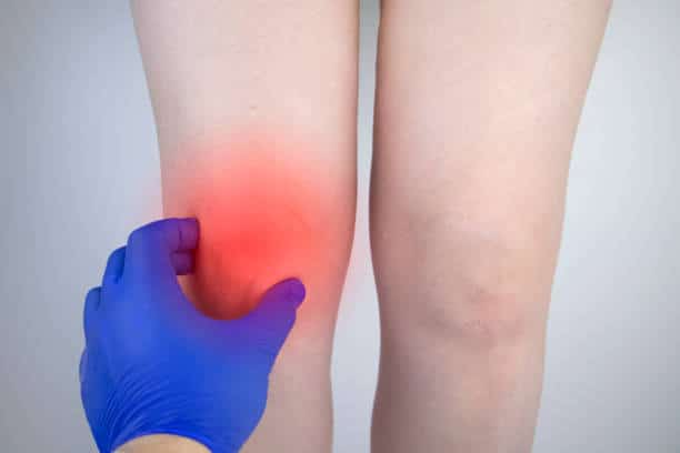 Comment résorber un oedème genou ?